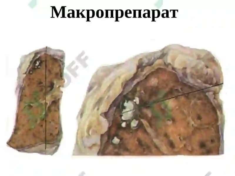 ОЧАГОВЫЙ, ИНФИЛЬТРАТИВНЫЙ ТУБЕРКУЛЕЗ ЛЕГКИХ 7