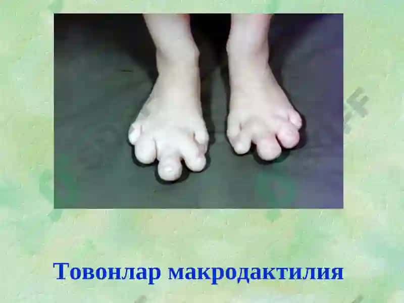Туғма оёқ-қўл нуқсонлари 7
