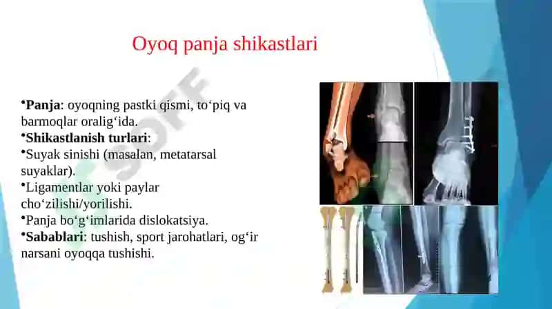Boldir suyaklari va oyoq panja shikastlari 7