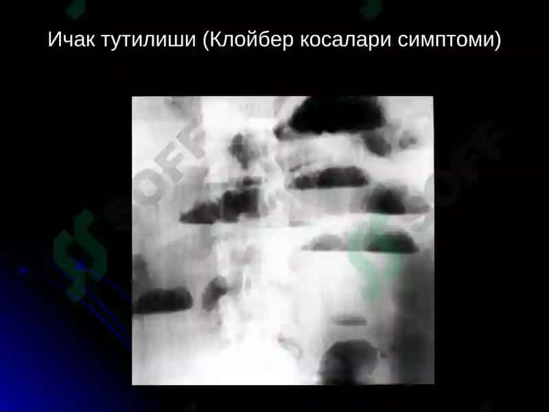 ОШКОЗОН-ИЧАК КАСАЛЛИКЛАРИ НУР ТАШХИСИ 7