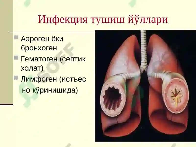 Болаларда Пневмония 7