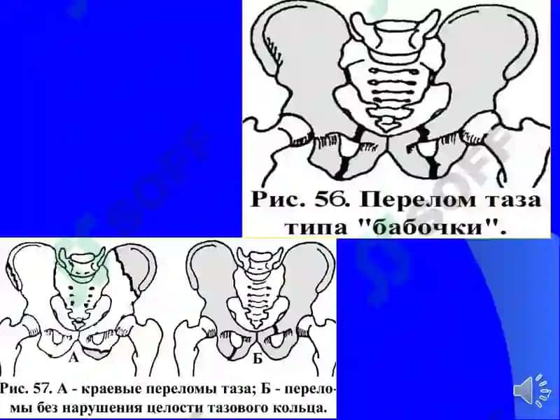 Чаноқ шикастлари 7