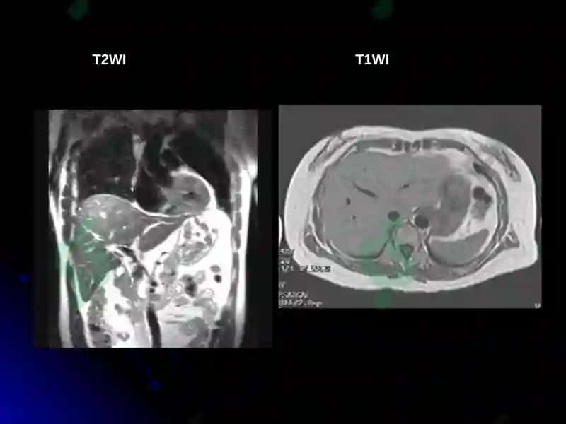 IMAGING OF LIVER DISEASES 8