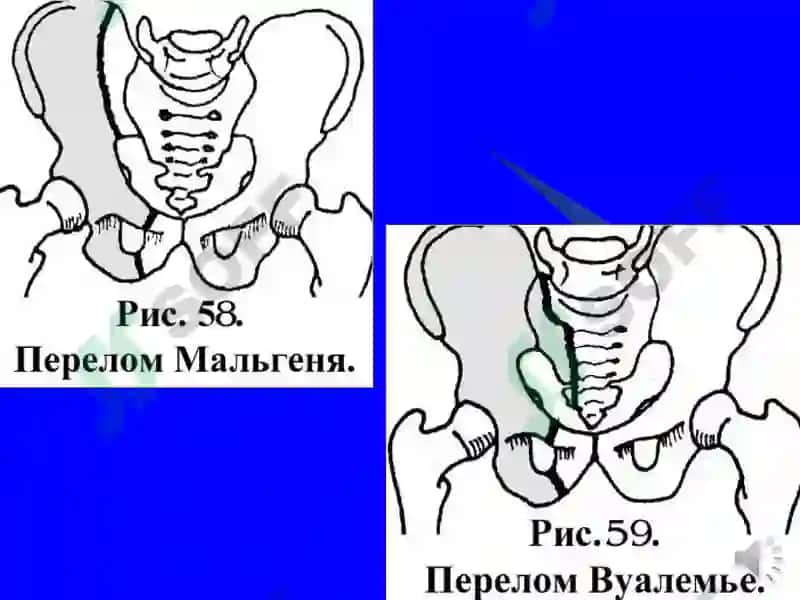 Чаноқ шикастлари 8