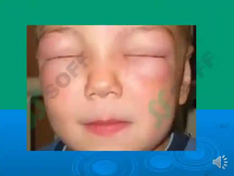 ШИШ СИНДРОМИ ДИФФЕРЕНЦИАЛ ДИАГНОСТИКАСИ. Shish sindromi differensial diagnostikasi 8