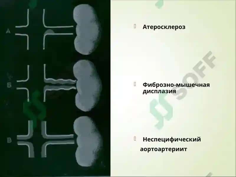 Вазоренальная гипертензия 8