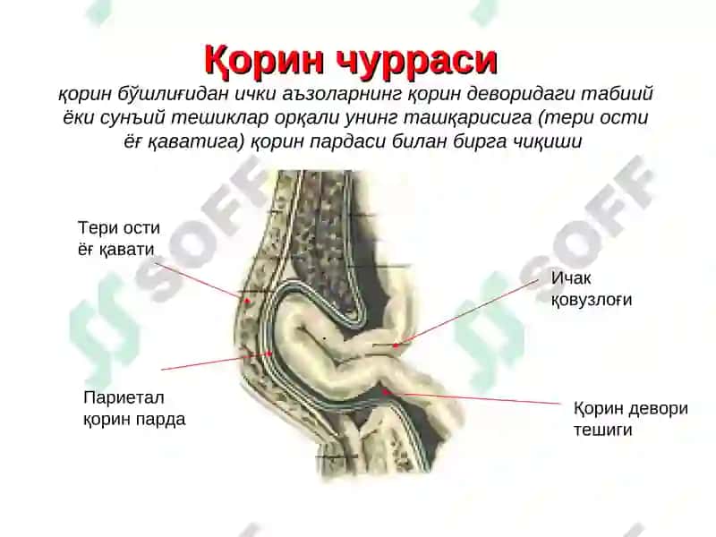 Қорин чурраларива унинг асоратлари 8