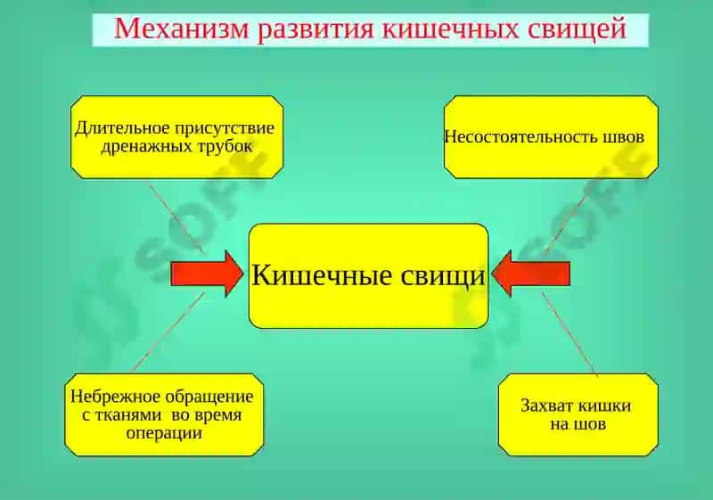 Кишечные свищи 8