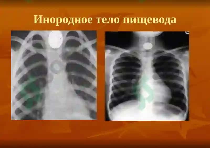 Лучевая диагностика заболеваний пищеварительной системы 8