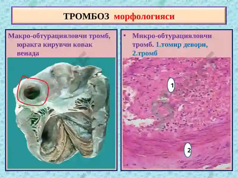 ПАТОЛОГИК АНАТОМИЯ 8