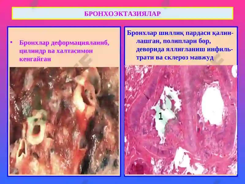 ПАТОЛОГИК АНАТОМИЯ 8