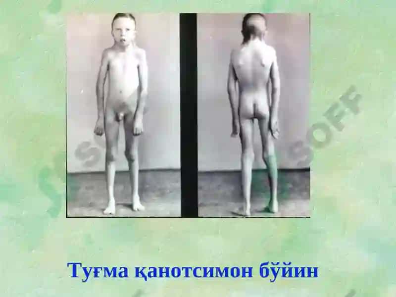 Туғма оёқ-қўл нуқсонлари 8