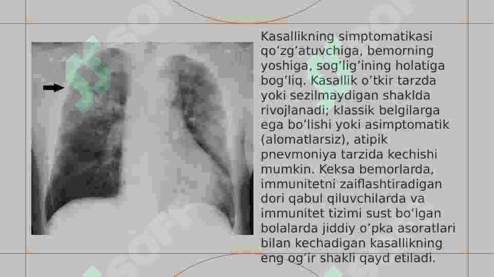 BOLALARDA ZOTILJAM KASALLIGI,  BAHOLASH,  TASNIFLASH VA DAVOLASH 6