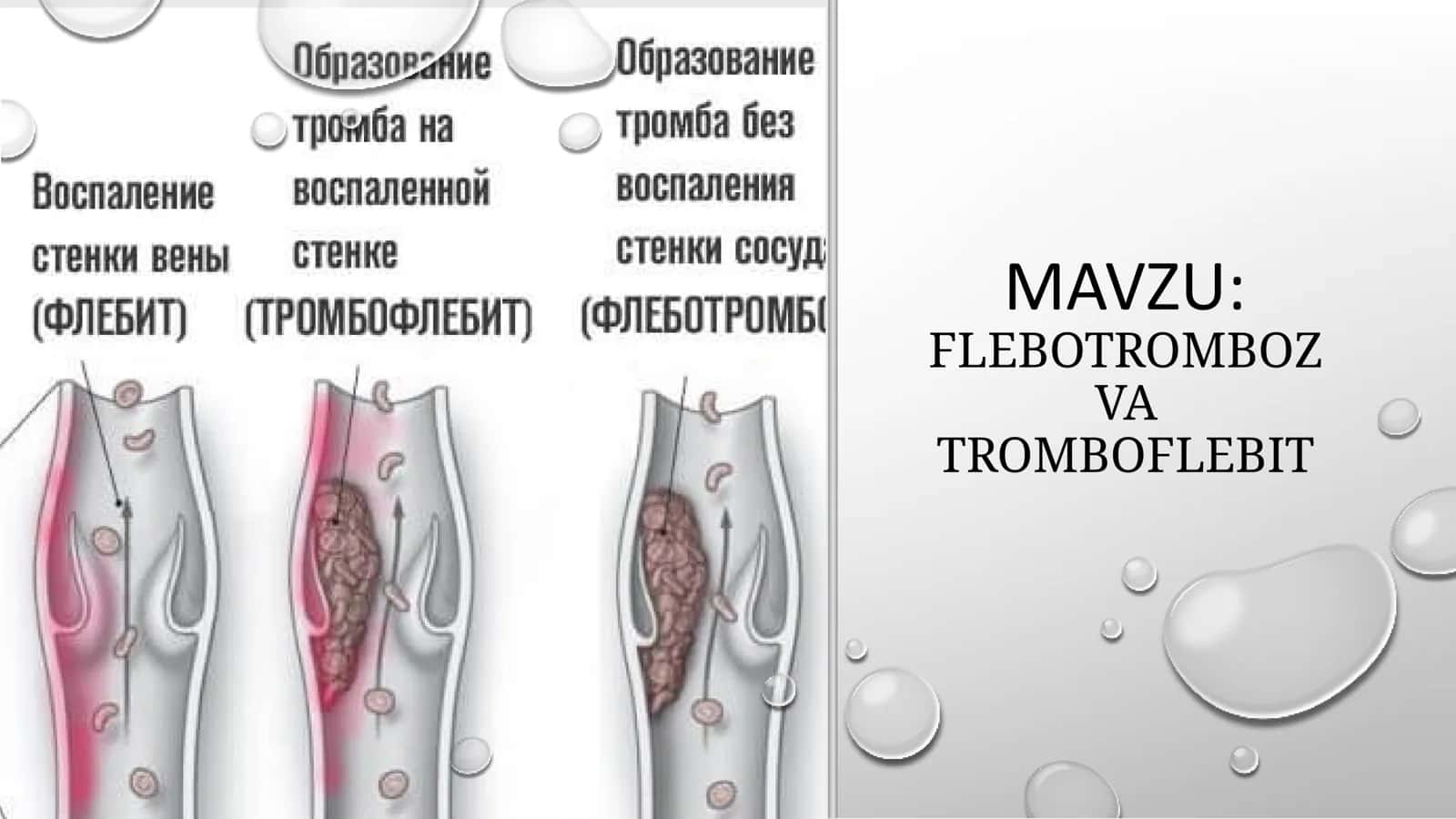 FLEBOTROMBOZ VA TROMBOFLEBIT