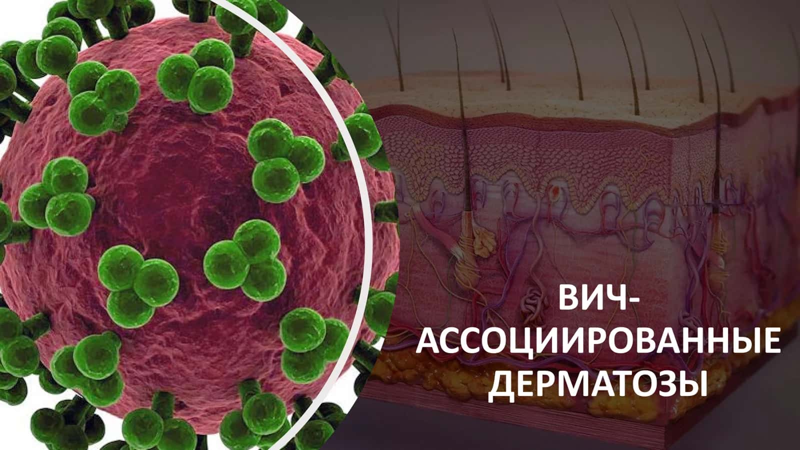 ВИЧ-АССОЦИИРОВАННЫЕ ДЕРМАТОЗЫ