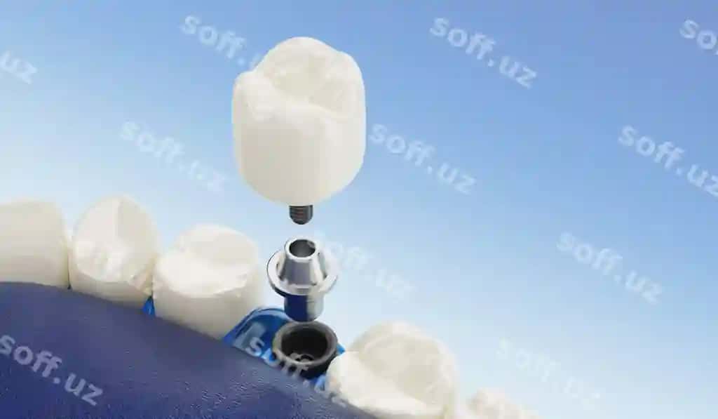 Yaqin qarash komponent dental implantatsiyalari shaffof 3D render | Close up component dental implants transparent 3d rendering