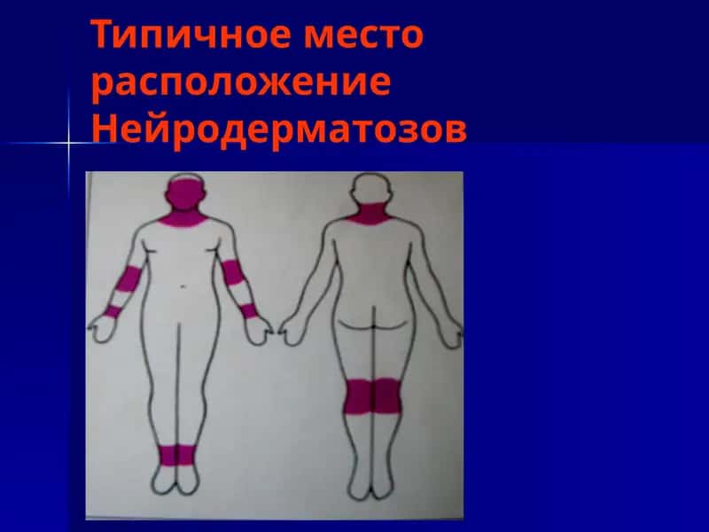 Нейродермит