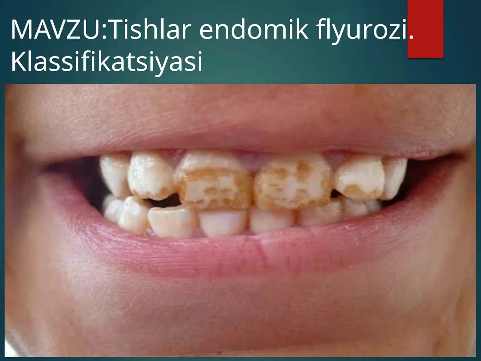 Tishlar endomik flyurozi. Klassifikatsiyasi