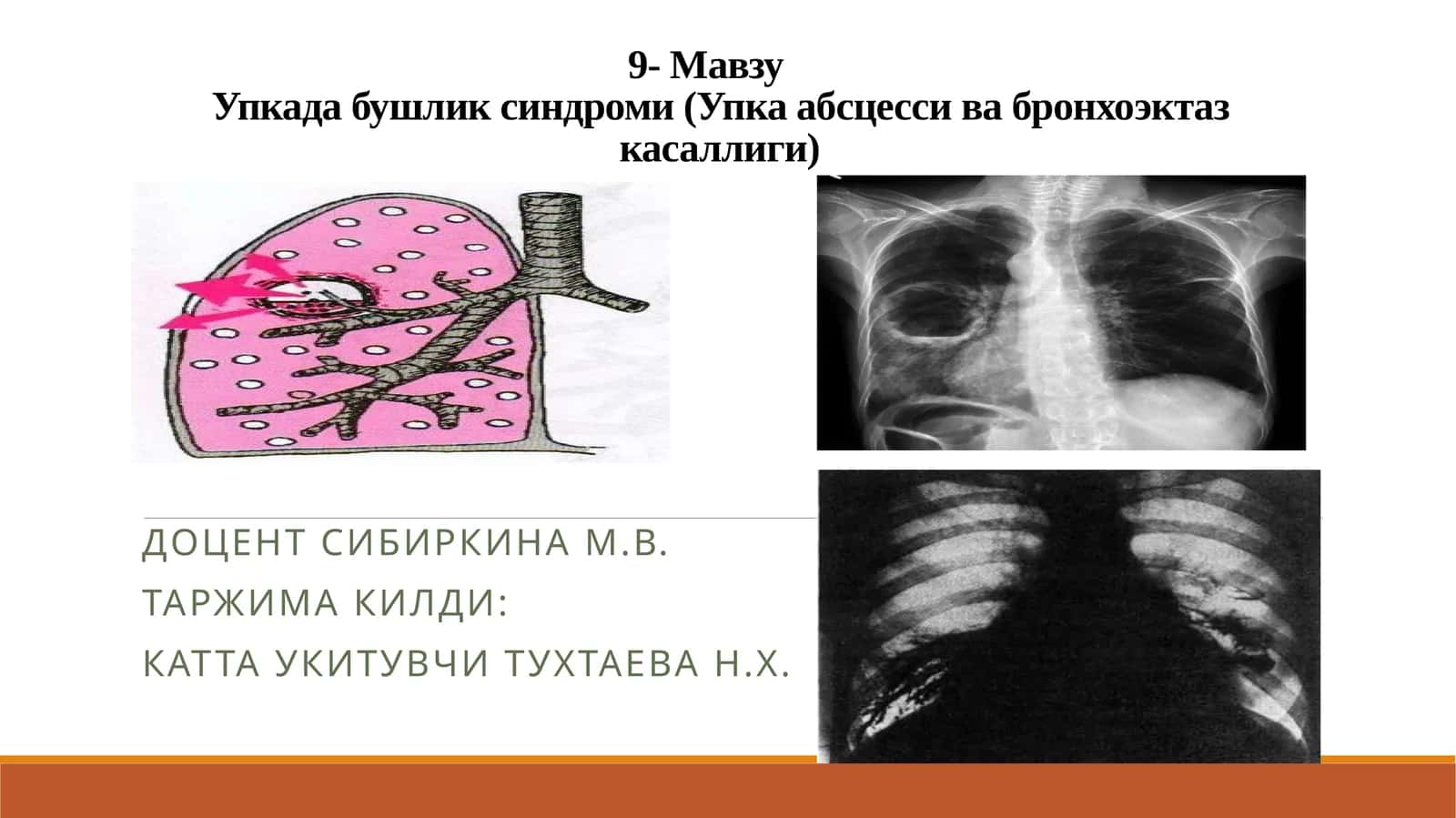 Упкада бушликсиндроми(Упка абсцесси ва бронхоэктаз касаллиги)