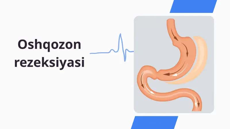 Oshqozon rezeksiyasi