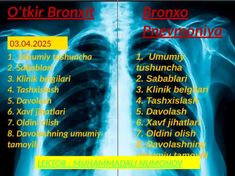 O'tkirBronxit