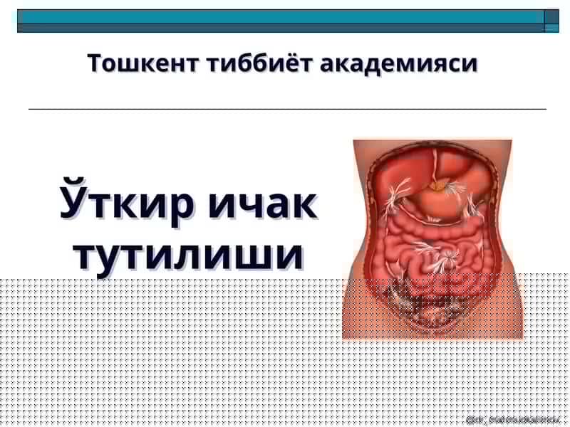 Ўткир ичак тутилиши