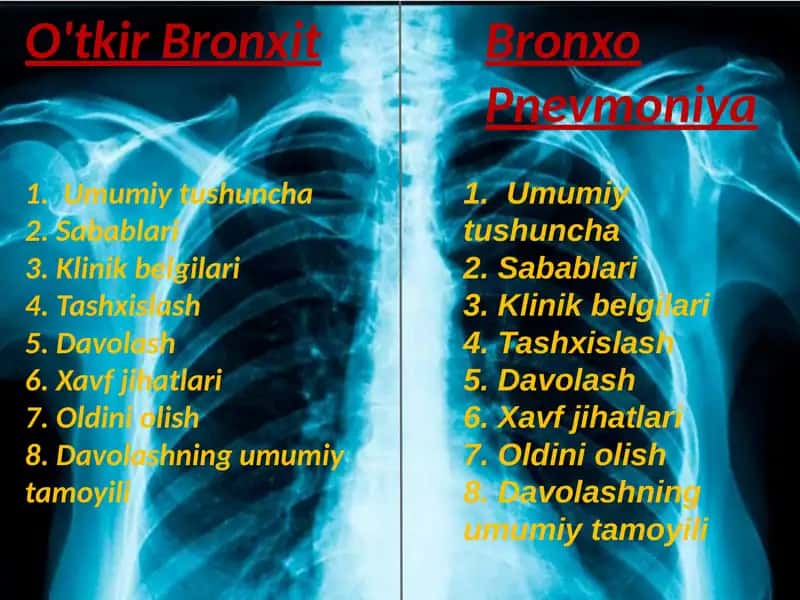 O'tkir Bronxit. Bronxopnevmoniya