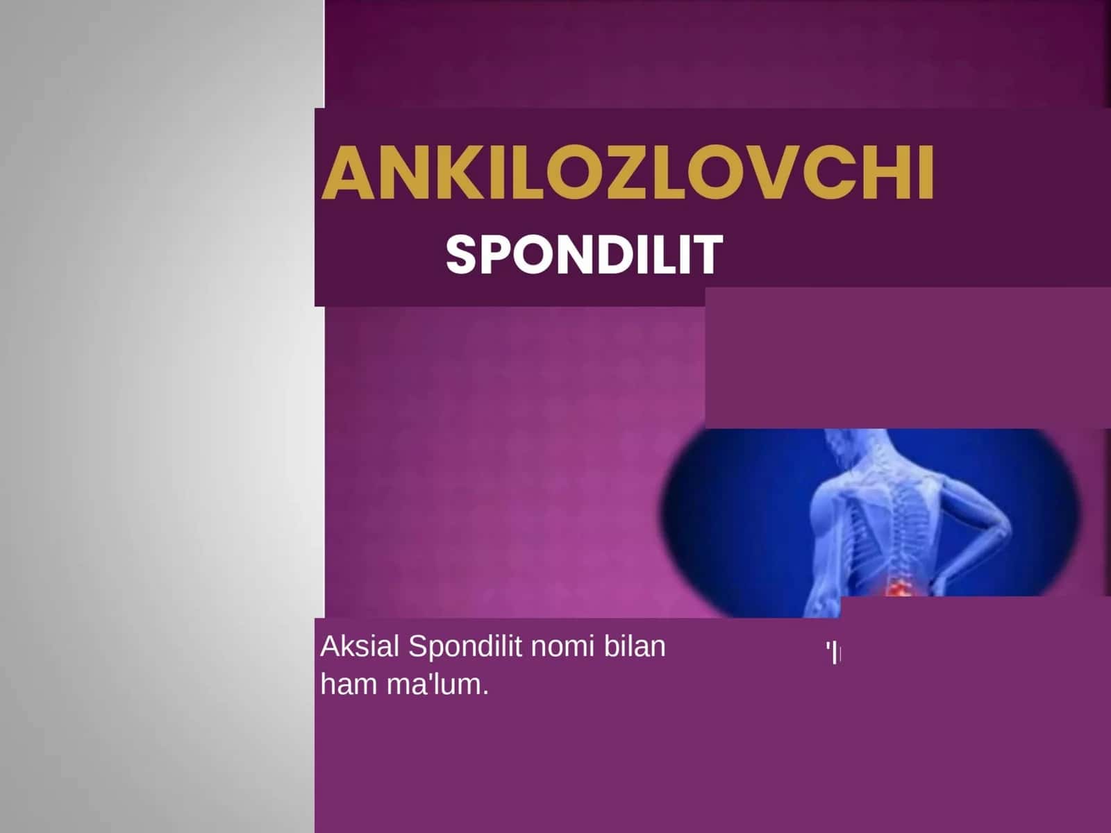 Ankilozlovchi Spondilit