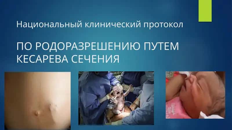 Национальный клинический протокол ПО РОДОРАЗРЕШЕНИЮ ПУТЕМ КЕСАРЕВА СЕЧЕНИЯ