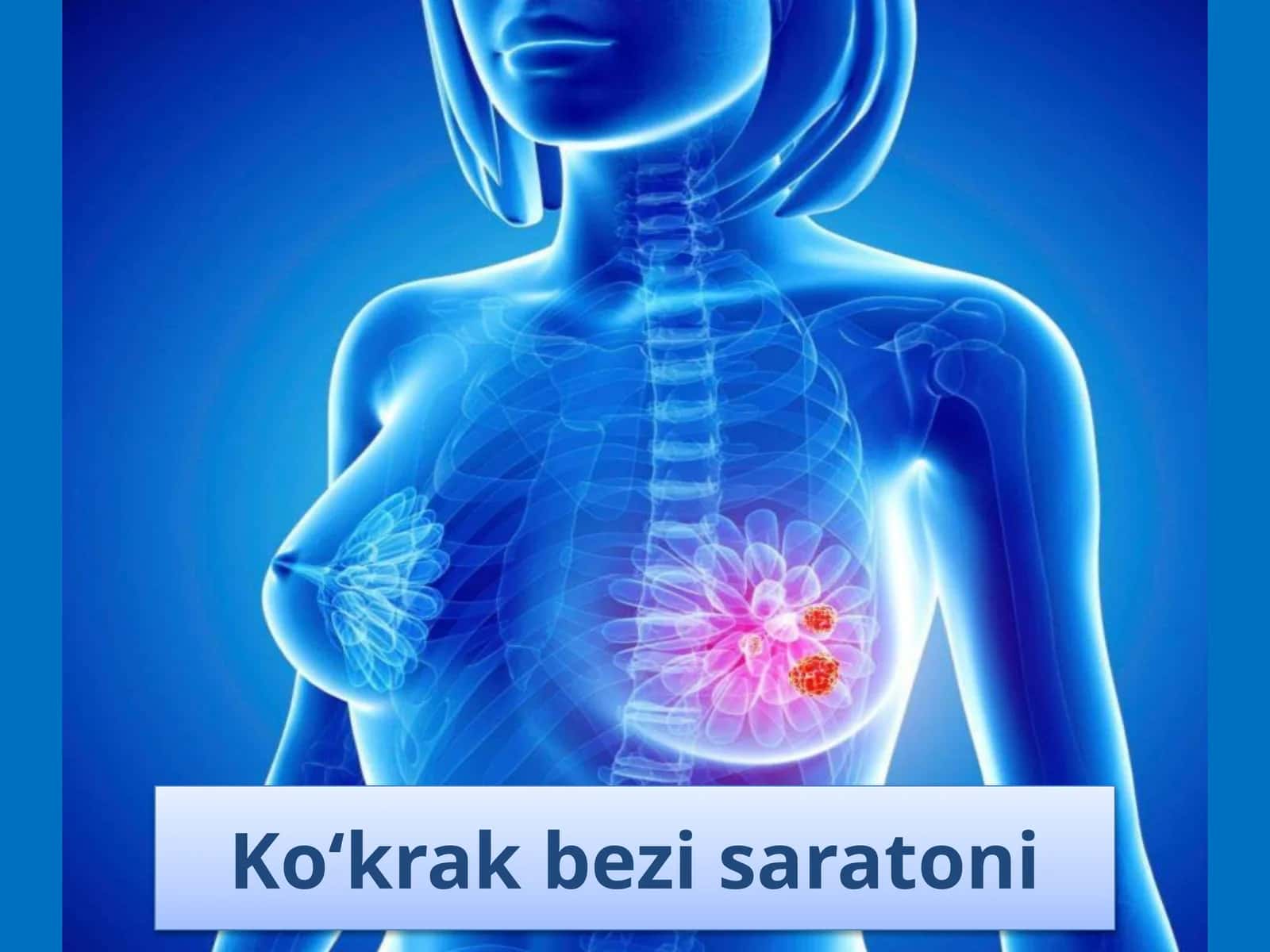 Ko‘krak bezi saratoni