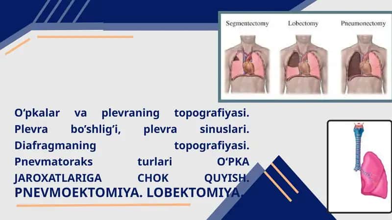 O‘pkalar va plevraning topografiyasi. Plevra bo’shlig’i, plevra sinuslari. Diafragmaning topografiyasi. Pnevmatoraks turlari O‘PKA JAROXATLARIGA CHOK QUYISH. PNEVMOEKTOMIYA. LOBEKTOMIYA.