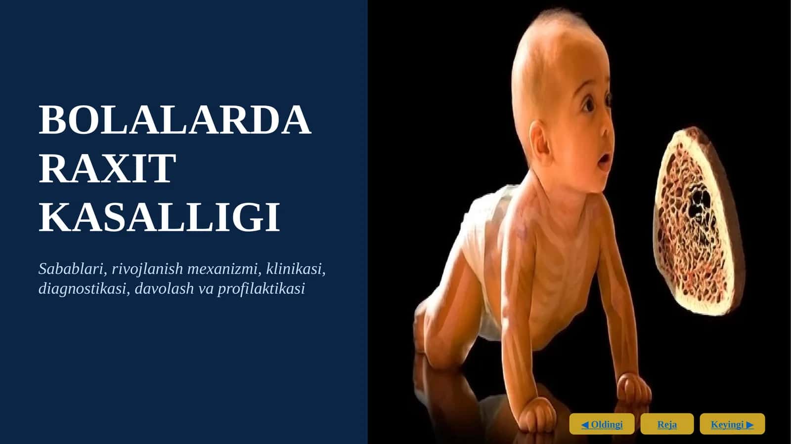 BOLALARDA RAXIT KASALLIGI BOLALARDA RAXIT KASALLIGI slayd