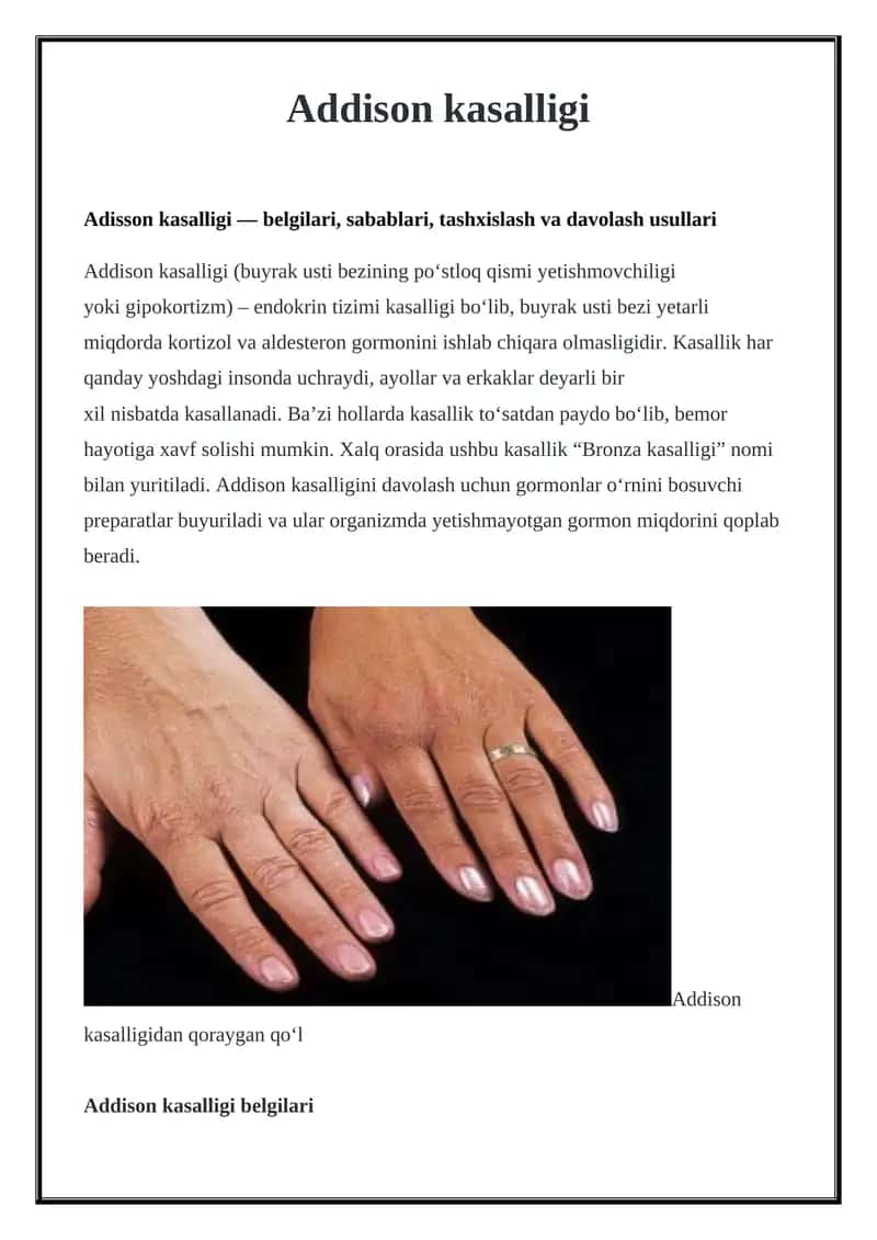 Addison kasalligi
