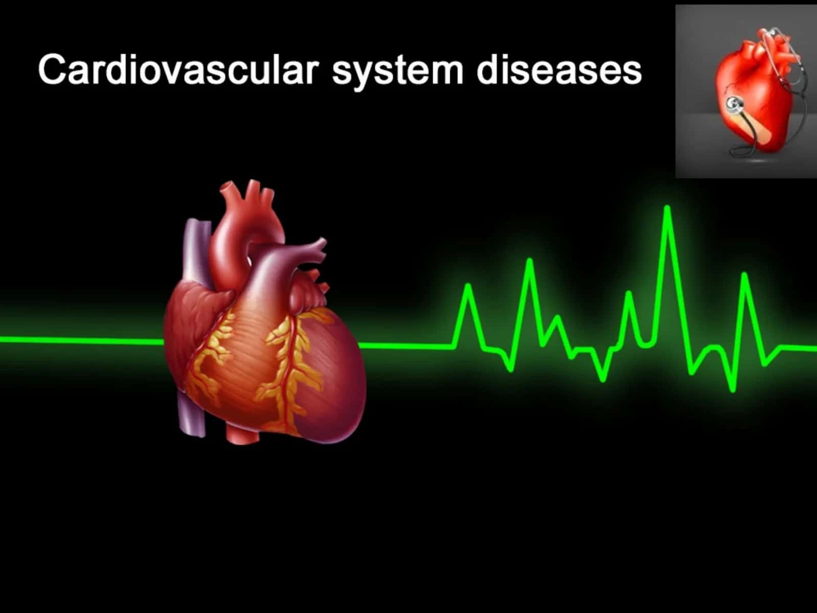 Angina Pectoris