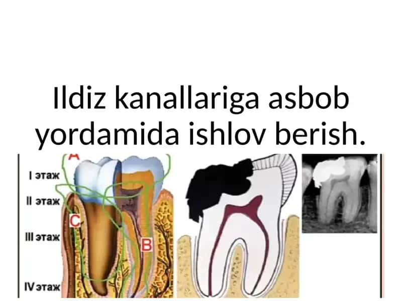 Ildiz kanallariga asbob yordamida ishlov berish