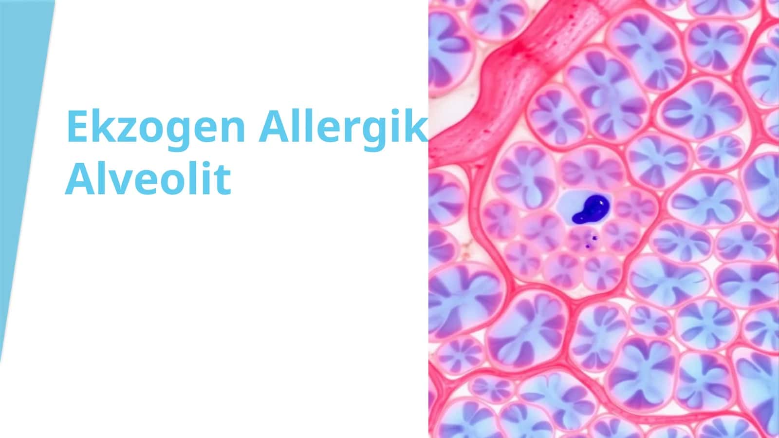 Ekzogen Allergik Alveolit