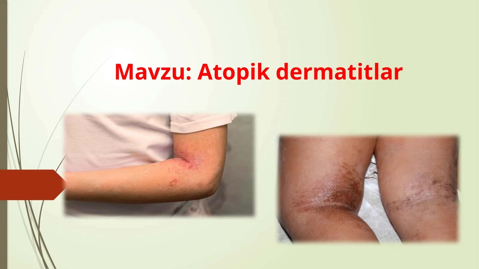 Atopik dermatitlar