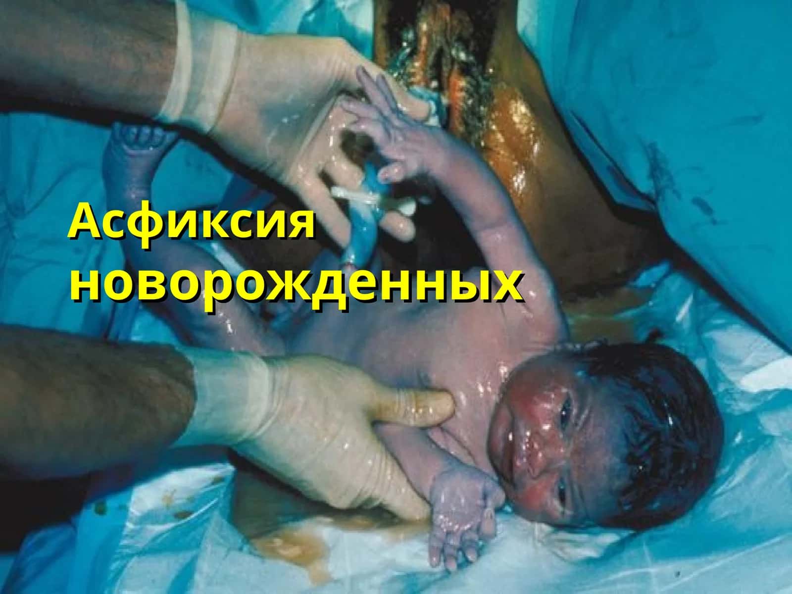 Асфиксияноворожденных