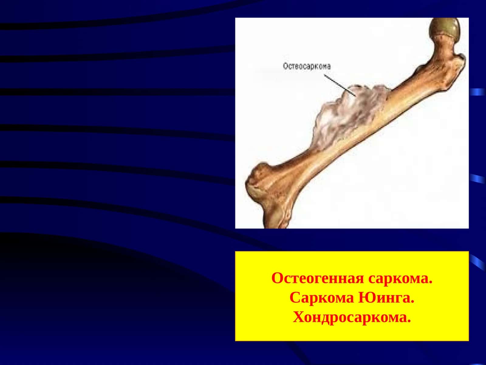 Остеогенная саркома. Саркома Юинга. Хондросаркома