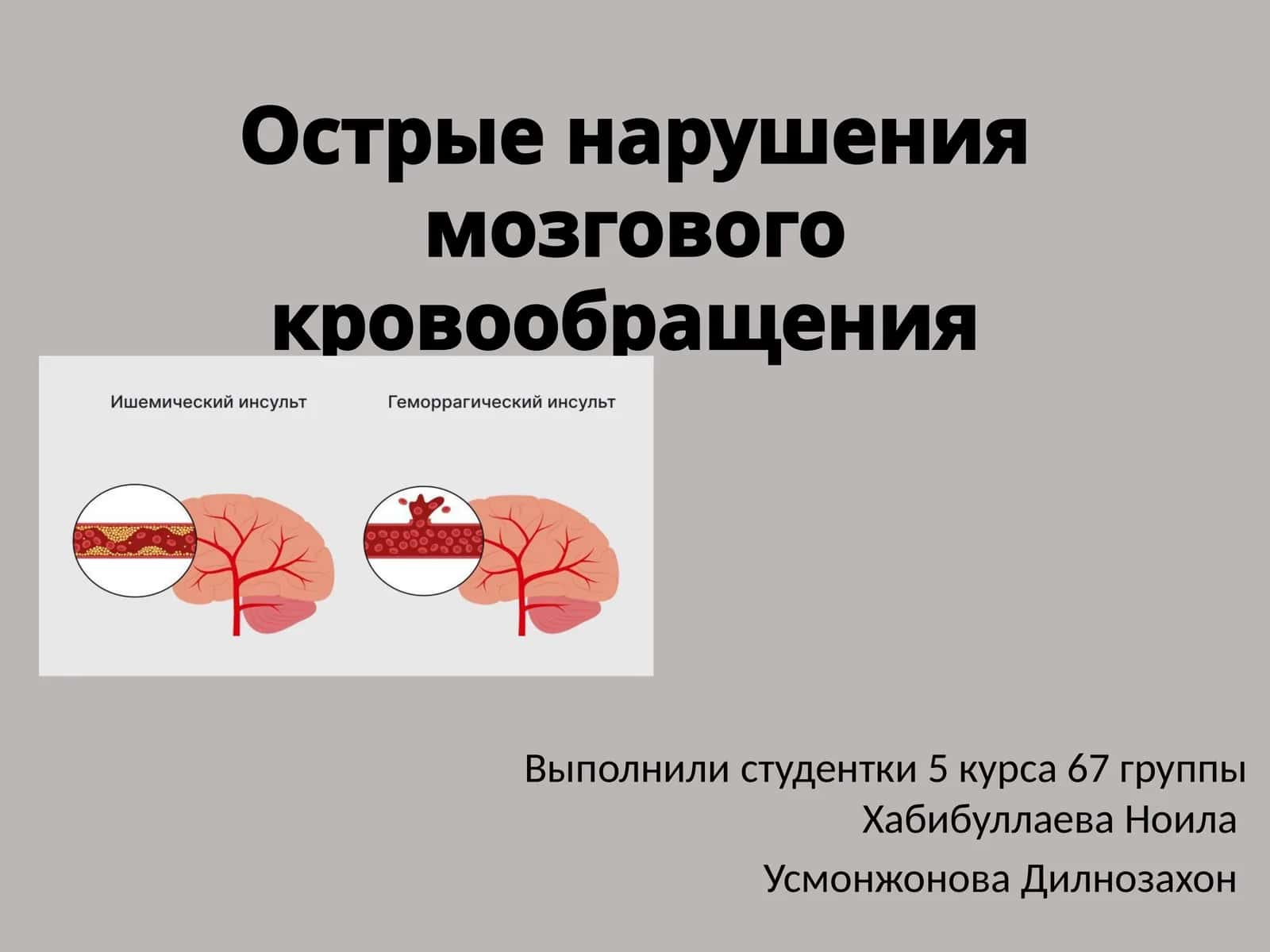 Острые нарушения мозгового кровообращения
