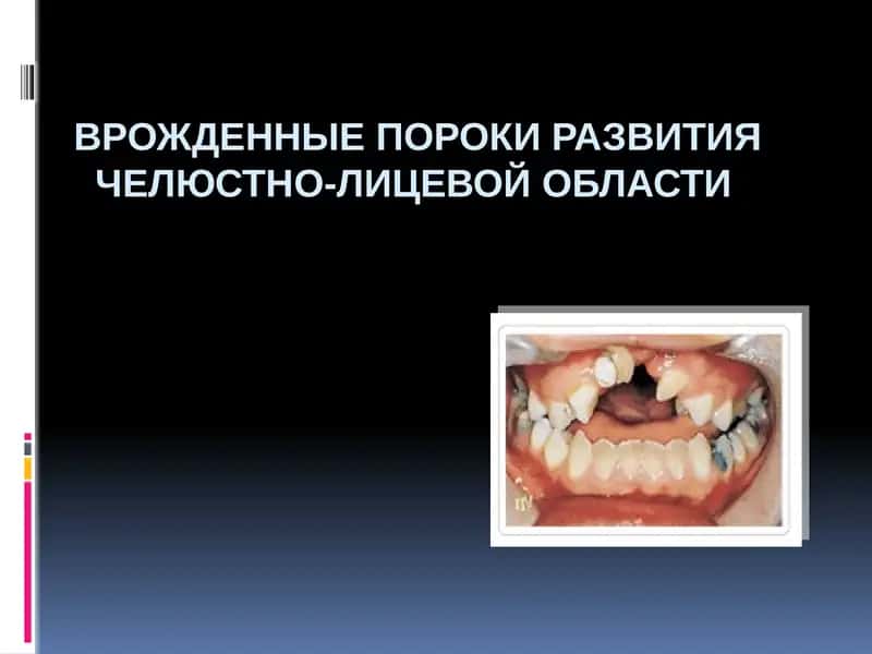 Врожденные пороки развития челюстно-лицевой области