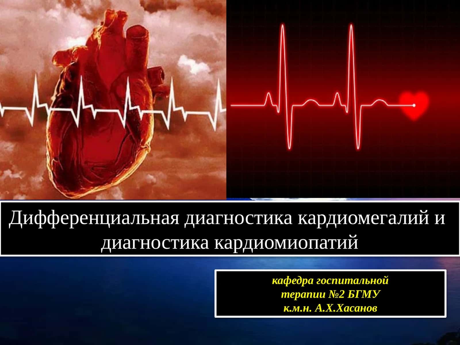 Дифференциальная диагностика кардиомегалий