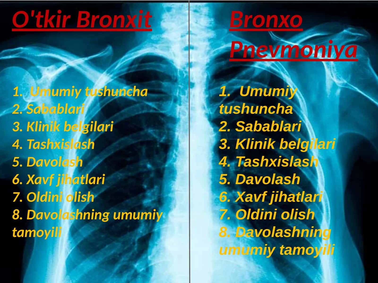 O'tkir Bronxit