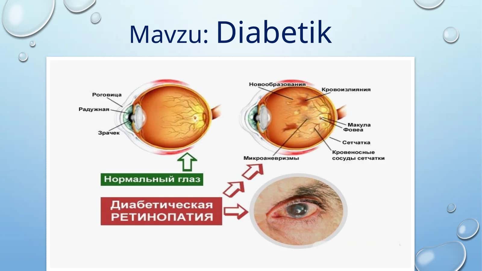 Diabetik retinopatiya