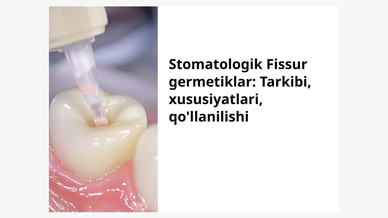 Stomatologik Fissur germetiklar: Tarkibi, xususiyatlari, qo'llanilishi