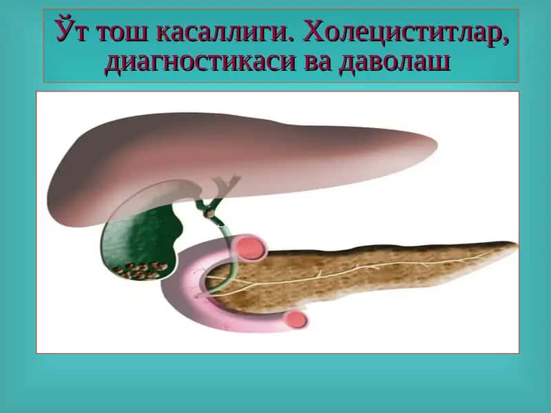 Ўт тош касаллиги. Холециститлар, диагностикаси ва даволаш