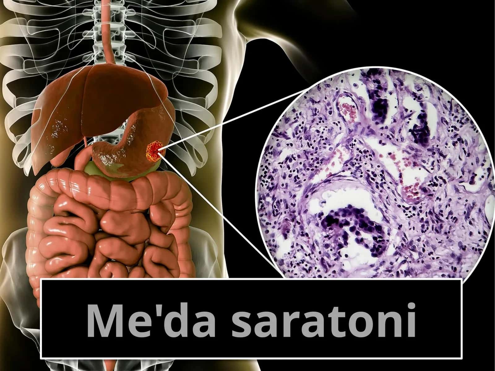 Me'da saratoni