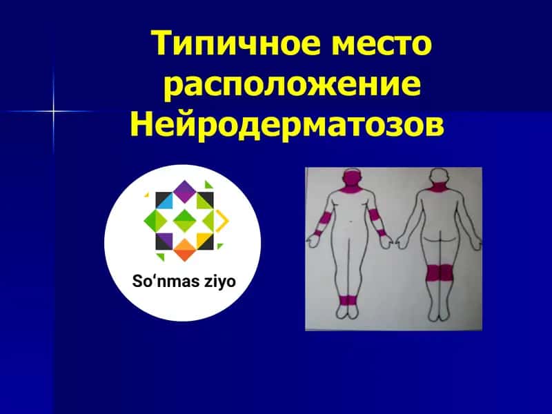 Типичное место расположение Нейродерматозов