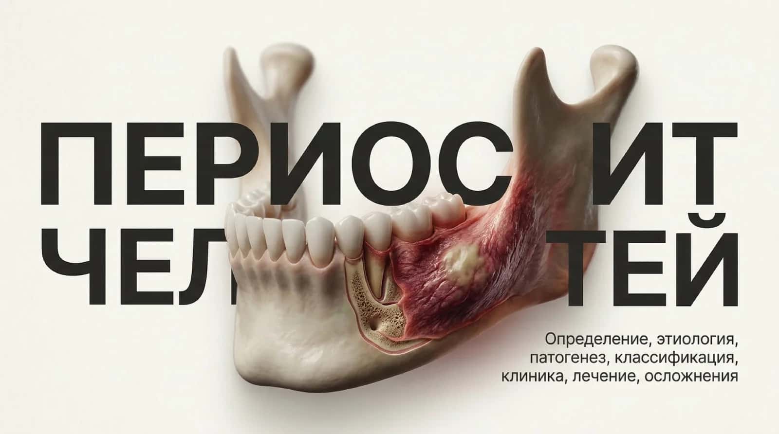 Периостит челюстий