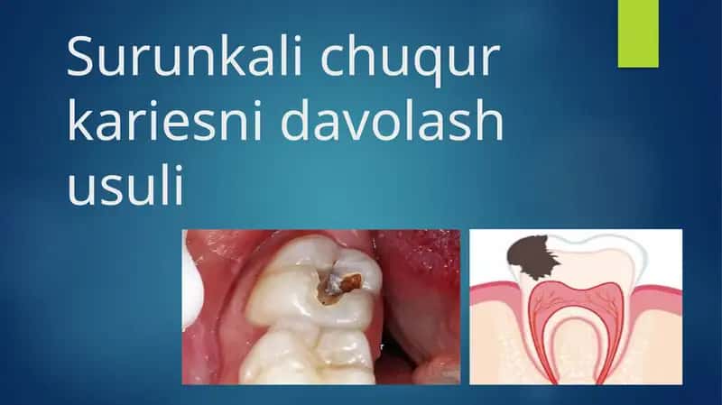 Surunkali chuqur kariesni davolash usuli